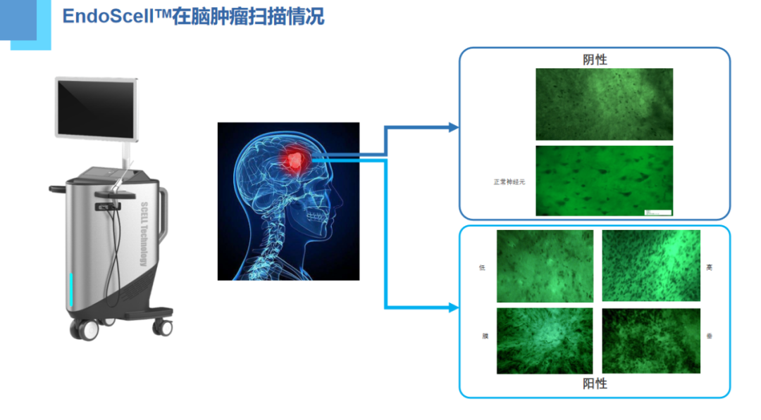 術(shù)中手持顯微鏡EndoSCell?（安刀）亮相2024天壇腦網(wǎng)絡(luò)神經(jīng)外科年會(huì)，細(xì)胞級(jí)精準(zhǔn)手術(shù)方案成為焦點(diǎn)(圖4)