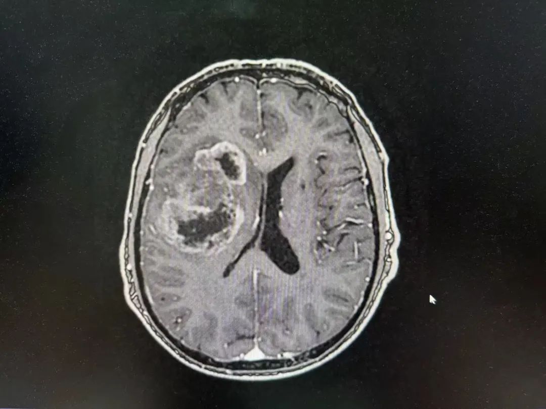 河北醫(yī)大二院應用細胞級熒光導引精準技術，突破高級別膠質瘤手術的裸眼限制(圖3)